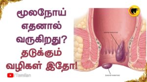 மூலநோய் எதனால் வருகிறது? தடுக்கும் வழிகள் இதோ!