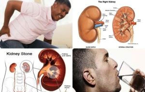 சிறுநீரக கற்கள் ஆண்களுக்கு அதிகம் ஏற்படக் காரணம் இவைதான்..!