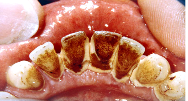இவை ஒரு ஸ்பூன் போதும்… உங்கள் பற்களின் மஞ்சள் கறை இருந்த இடம் தெரியாமல் போய்விடும்..!
