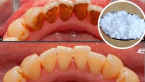 பற்களின் பின்னால் உள்ள கறைகளைப் போக்குவதற்கான எளிய வழிகள்!!!