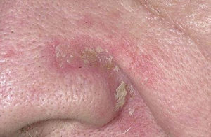 உங்களுக்கு மூக்கைச் சுற்றி தோல் உரியுதா? இதோ சில டிப்ஸ்…!