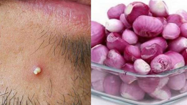 சீழ் நிறைந்த பருக்களைப் போக்குவதற்காக வெங்காயத்தை எப்படி பயன் படுத்த வேண்டும் தெரியுமா?