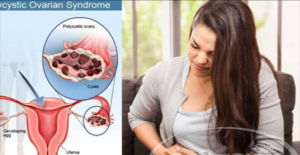 நீர்க்கட்டி பிரச்சனையை சரிசெய்யும் இயற்கை மருத்துவம் இது தான்..!