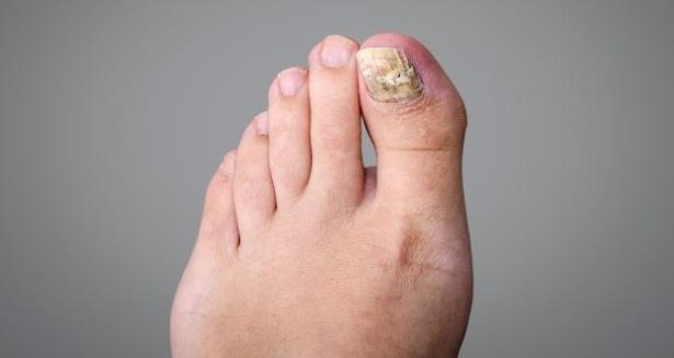 சொத்தையான கால் நகங்கள் உள்ளதா? இதெல்லாம் ட்ரை பண்ணுங்க!