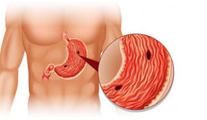 அல்சர் வருவதற்கான காரணங்கள் மற்றும் குணமடையும் வழிகள்….!