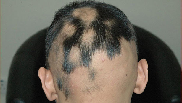 புழுவெட்டு நோய் அதிகளவானோருக்கு ஏன் வருகிறது தெரியுமா? இத முதல்ல படியுங்க..!