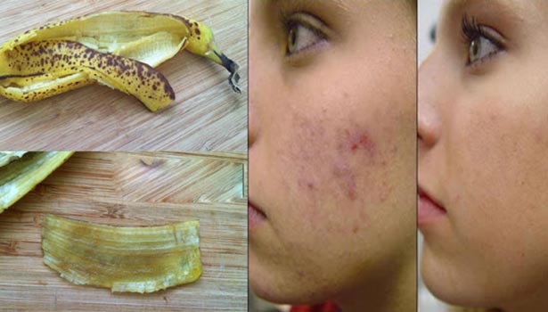 வாழைப்பழத்தோலை இப்படி பயன்படுத்தினால் முகப்பரு இருந்த இடம் தெரியாமல் போகும்!