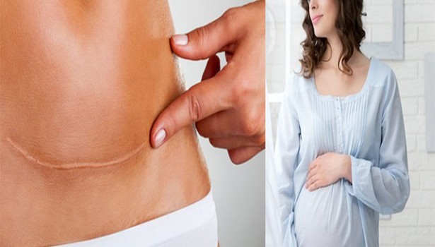 பெண்கள் பலமுறை சிசேரியன் செய்தால் உடலில் ஏற்படும் விளைவுகள்..!