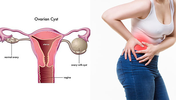 இந்த 6 அறிகுறிகள் இருந்தா கருப்பையில் கட்டி இருக்குனு அர்த்தம்..!