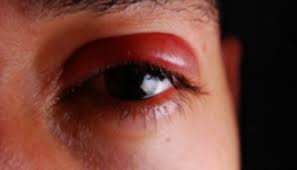 கண்கட்டியை விரைவில் குணப்படுத்த நாம் என்ன செய்ய வேண்டு?