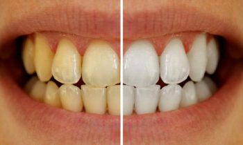 பற்களில் காணப்படும் மஞ்சள் நிறம் மாறைய…!!