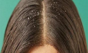 பொடுகு தொல்லை நீங்க…!