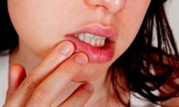 வாய்ப்புண் நீங்குவதற்குரிய இயற்கை மருத்துவம்…!!