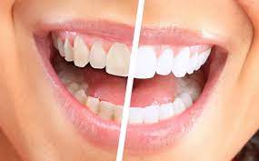 உங்கள் பற்கள் வெண்மையாக தோற்றம் அளிப்பதற்கு…!!