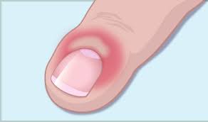 நக சுத்தி குணமாக..!!