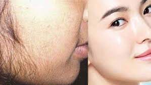 முகத்திலுள்ள முடிகளை அகற்ற நாம் என்ன செய்ய வேண்டும்?