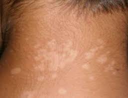 தேமல் மறைய….!!