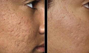 முகத்தில் உள்ள மேடு பள்ளங்கள் மறைய..!!