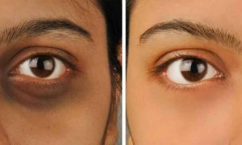 கருவளையம் நீங்க….!!!