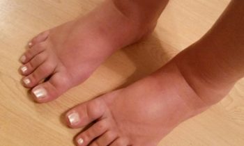 கால் வீக்கத்தினை குறைக்க….!