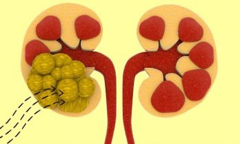 சிறுநீரக கற்கள் கரைய…!!!