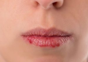 உதடு வெடிப்பா…?