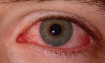 கண் நோய்கள்…!!