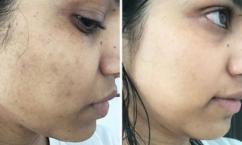 கருப்பு திட்டுகளை நீக்க…!!