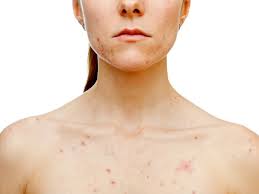 கட்டிகள் மற்றும் பருக்கள்…!!