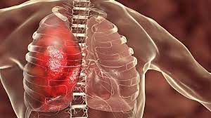 நுரையீரல் பாதிப்பு குறைய…!!