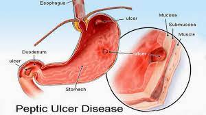 2வயிற்றுப்புண் சம்பந்தப்பட்ட அனைத்து பிரச்சனைகளையும் சரி செய்ய…!
