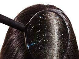 பொடுகு தொல்லையை போக்கும் எளிய வழிகள்..!!