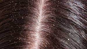 பொடுகு தொல்லை நீங்க..!!