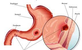 அல்சர் அறிகுறிகள்..!!!