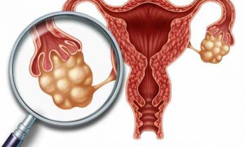 பெண்களுக்கு ஏற்படும் கருப்பை கட்டி கரைய சித்த மருத்துவம்…!!