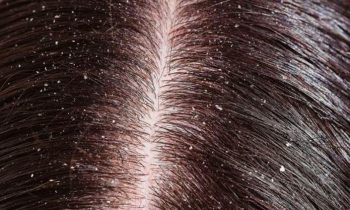 பொடுகு தொல்லை நீங்க..!!