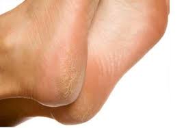 பாத வெடிப்பு குணமாக..!!