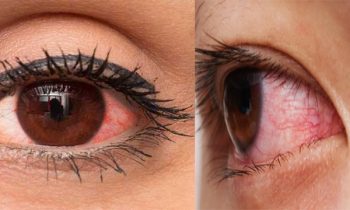 கண் பிரச்சனை..!!