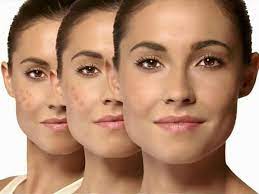 மூன்றே நாட்களில் கரும்புள்ளி நீங்க இதை செய்தால் போதும்..!