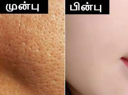 முகத்தில் உள்ள குழிகளை மறைக்க இயற்கை வழிகள்..!!