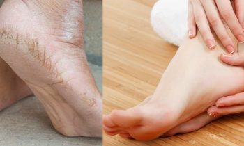 பாத வெடிப்பு குணமாக கிரீம்: