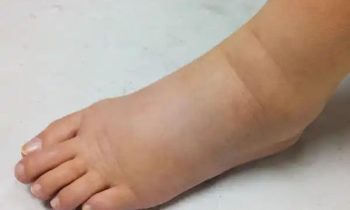 கர்ப்பத்தின் போது கால் வீக்கம் குறைய என்ன செய்யலாம்?