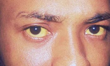 மஞ்சள் காமாலை குணமாக வீட்டு வைத்தியம்..!!