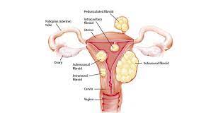 கருப்பை கட்டி கரைய சித்த மருத்துவம்…!