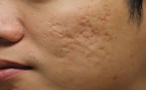 முகத்தில் உள்ள பள்ளங்கள் மறைய..!!!