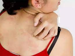 இயற்கை முறையில் அலர்ஜி, தடிப்புகள் நீங்க வீட்டு வைத்தியம்..!!