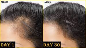 முன் நெற்றியில் முடி வளர என்ன செய்ய வேண்டும்?