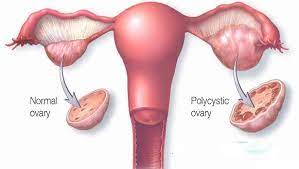 கருப்பை நீர்கட்டி கரைய சித்த மருத்துவம்.