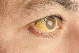 மஞ்சள் காமாலை குணமாக வீட்டு வைத்தியம்..!!