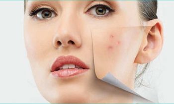 மூன்றே நாளில் முகப்பருவிற்கு உடனடி தீர்வு..!